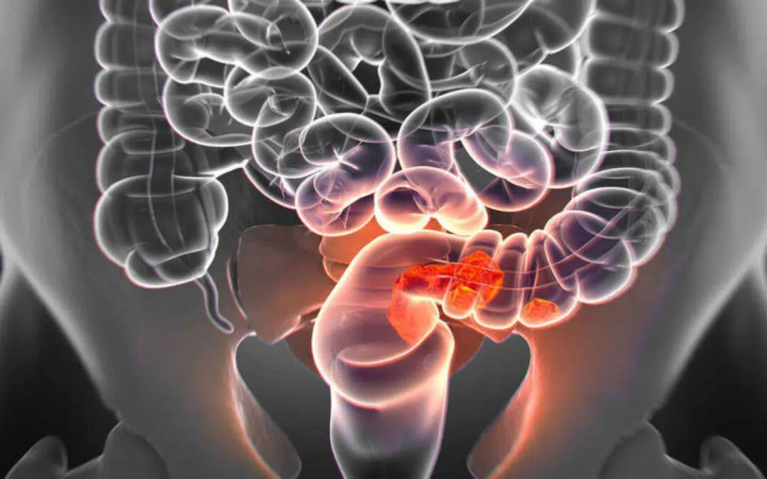 Cuáles son los exámenes de diagnóstico del cáncer colorrectal y determinan su avance