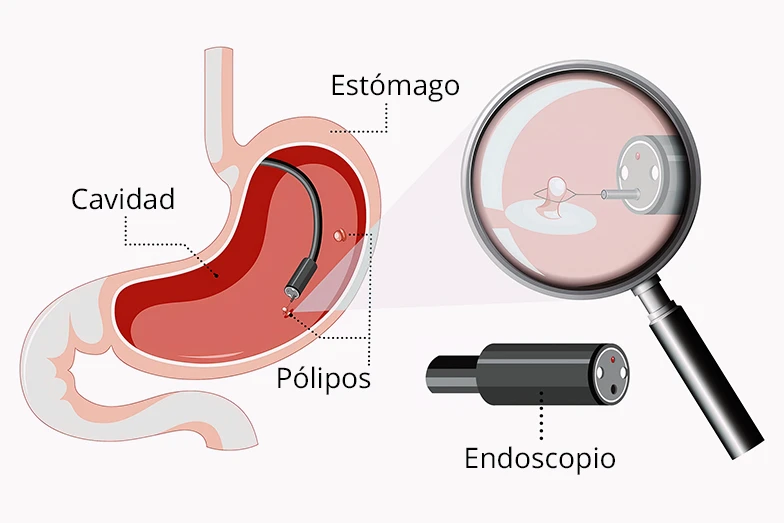 Como se hace una colonoscopia y extracción de pólipo