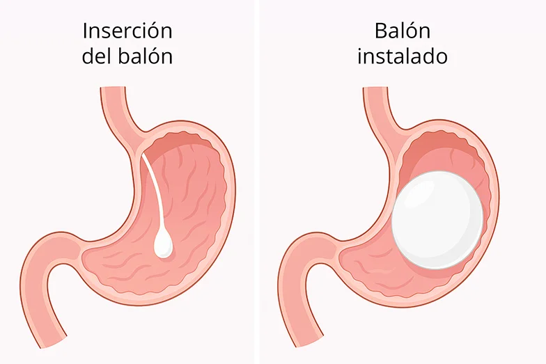 El balón gástrico se llena con una solución salina dentro del estómago Ilustración del balón gástrico en el estómago