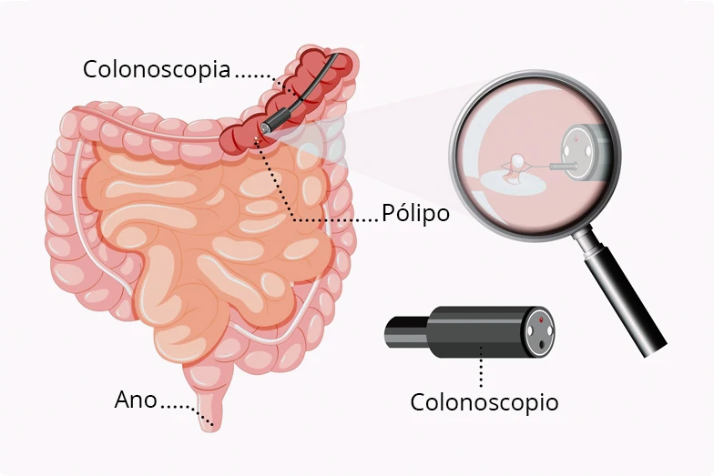 Como se hace una colonoscopia y extracción de pólipo