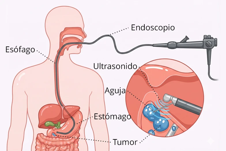 Ecoendoscopia con punción Ilustración de una ecoendoscopia con punción para detectar un tumor